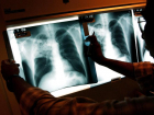 В Астраханской области улучшают систему диагностики туберкулеза