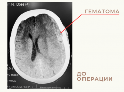 Астраханские врачи успешно удалили из головы 86-летней пациентки огромную гематому